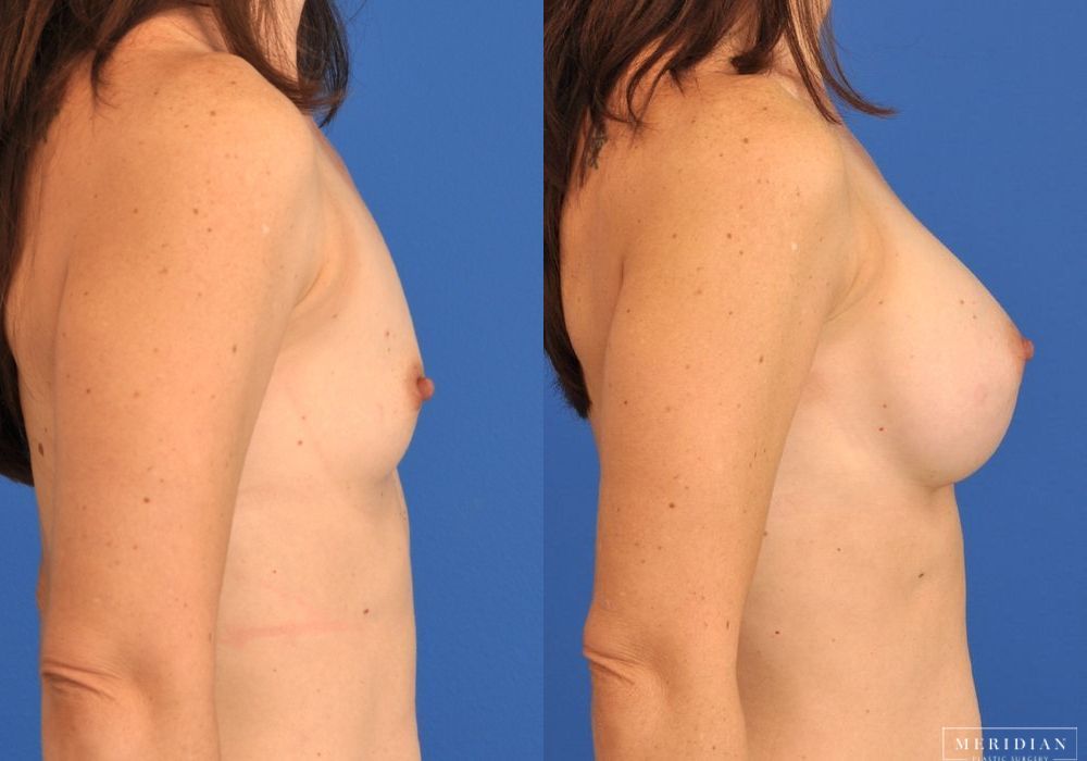 Breast Augmentation - Thumbnail 2