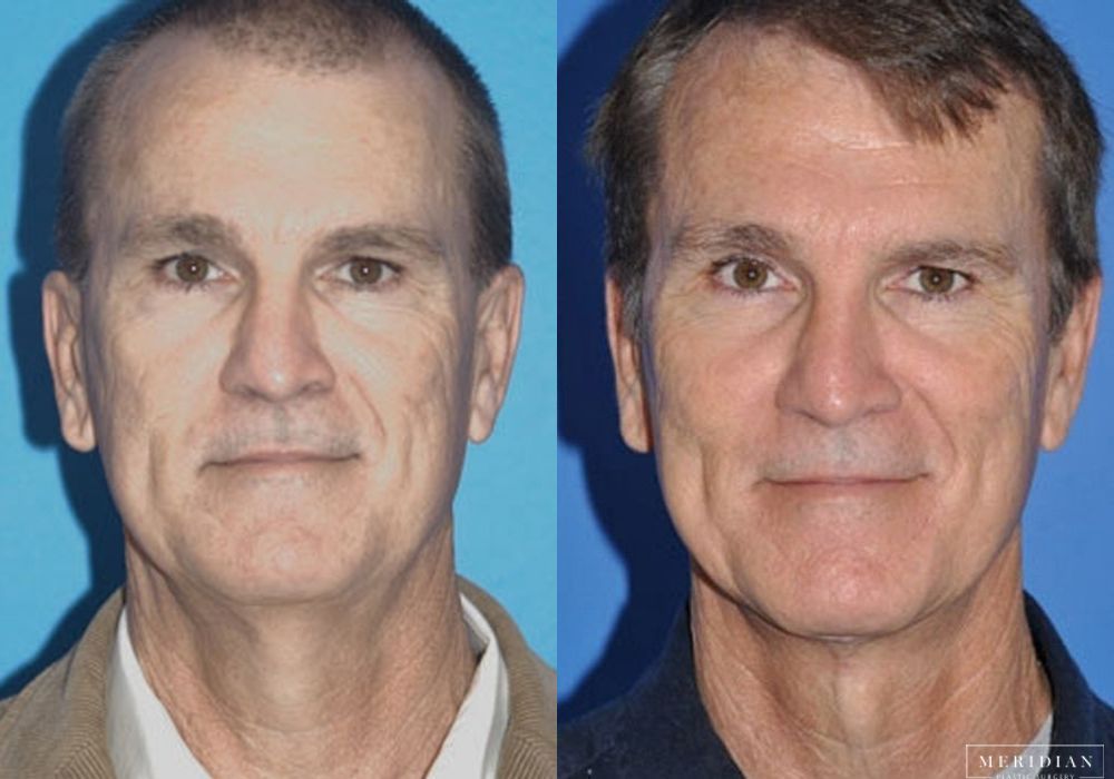 Facelift - Case 8121