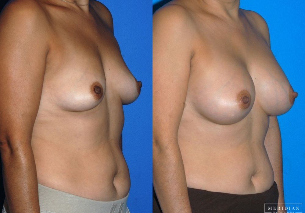 Breast Augmentation - Thumbnail 3