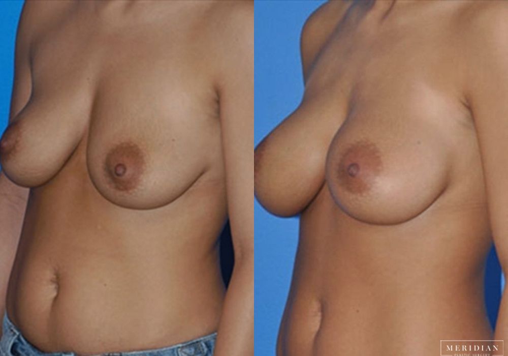 Breast Augmentation - Thumbnail 2