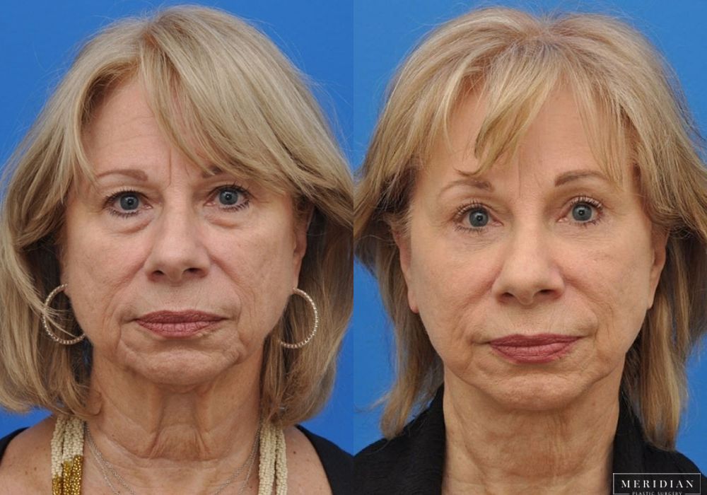 Neck Lift - Case 8130