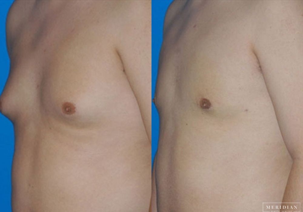 Gynecomastia - Case 7905