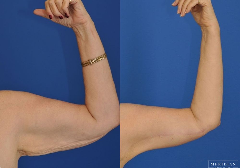 Arm Lift - Case 7755