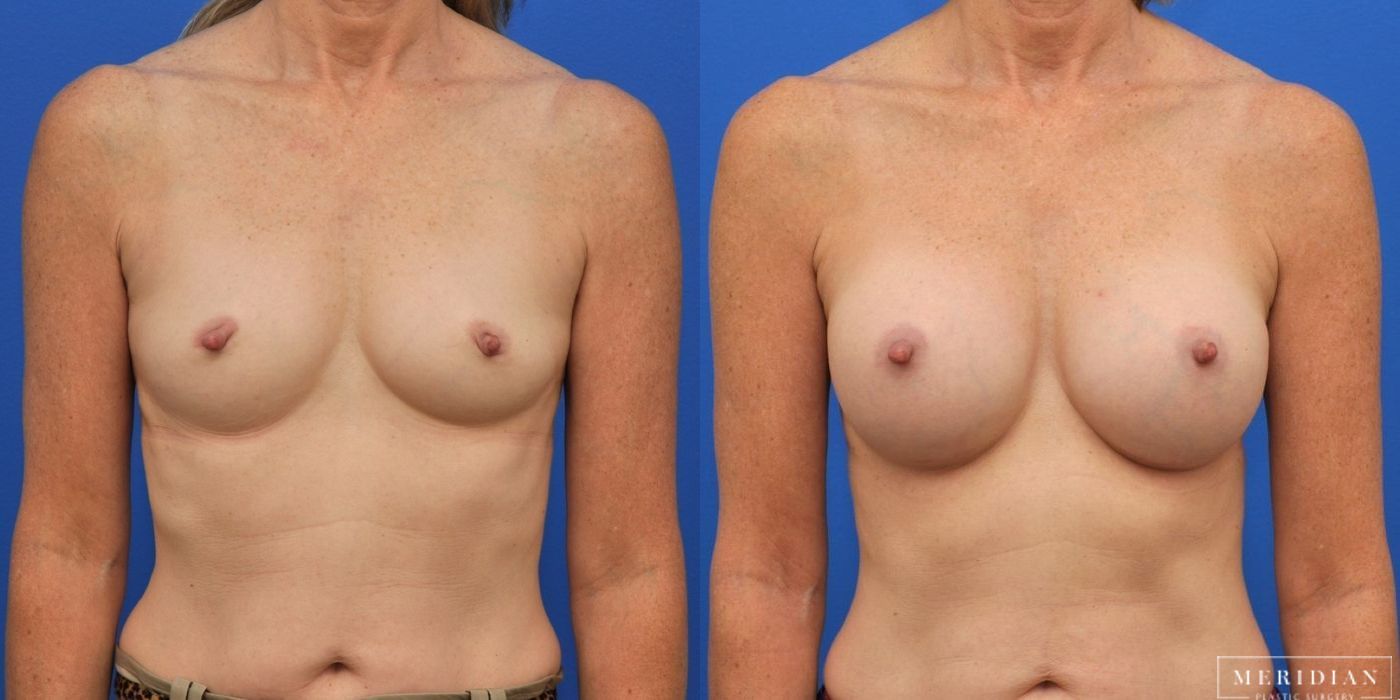 Before and after procedure result