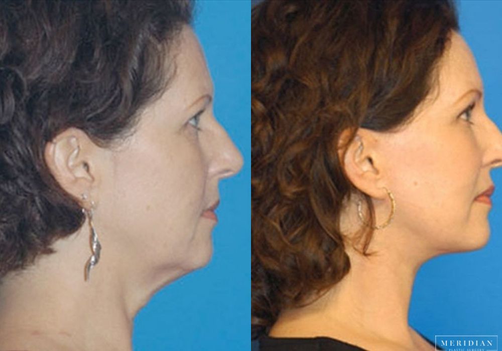 Brow Lift - Thumbnail 2