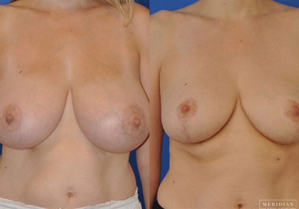 Breast Lift - Case 7871