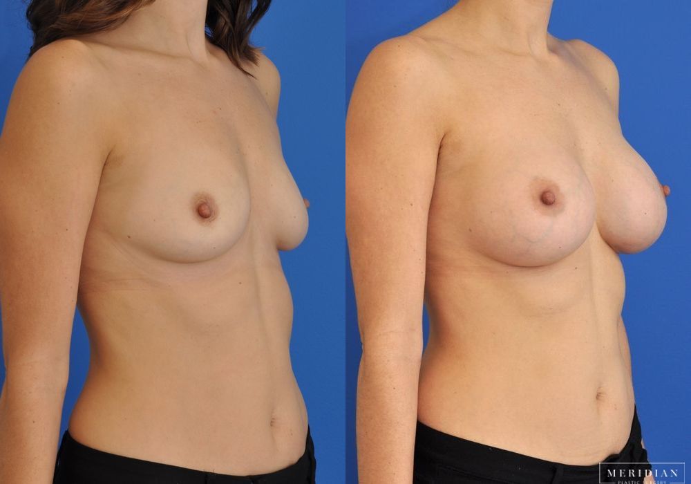 Breast Augmentation - Thumbnail 3