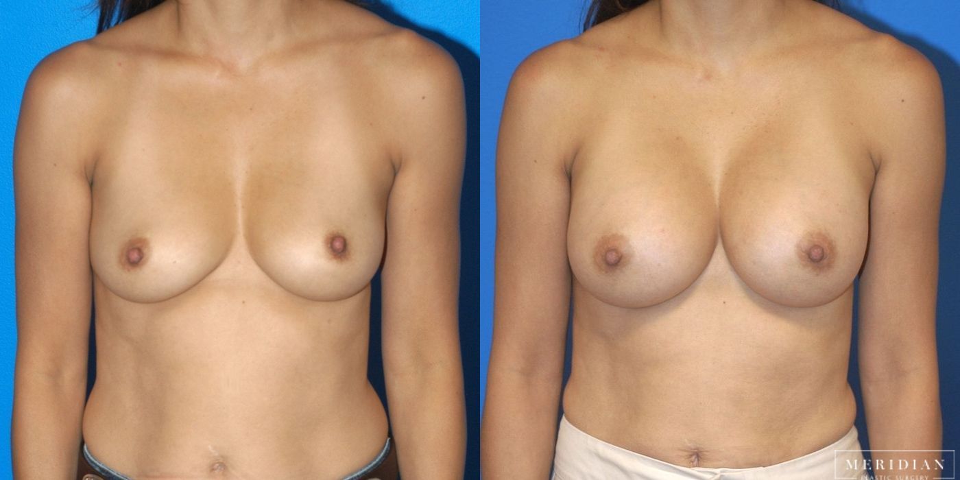 Before and after procedure result