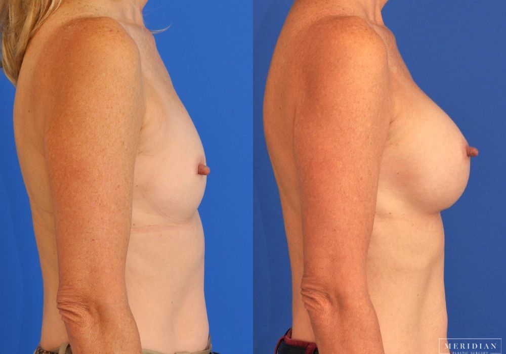 Breast Augmentation - Thumbnail 3
