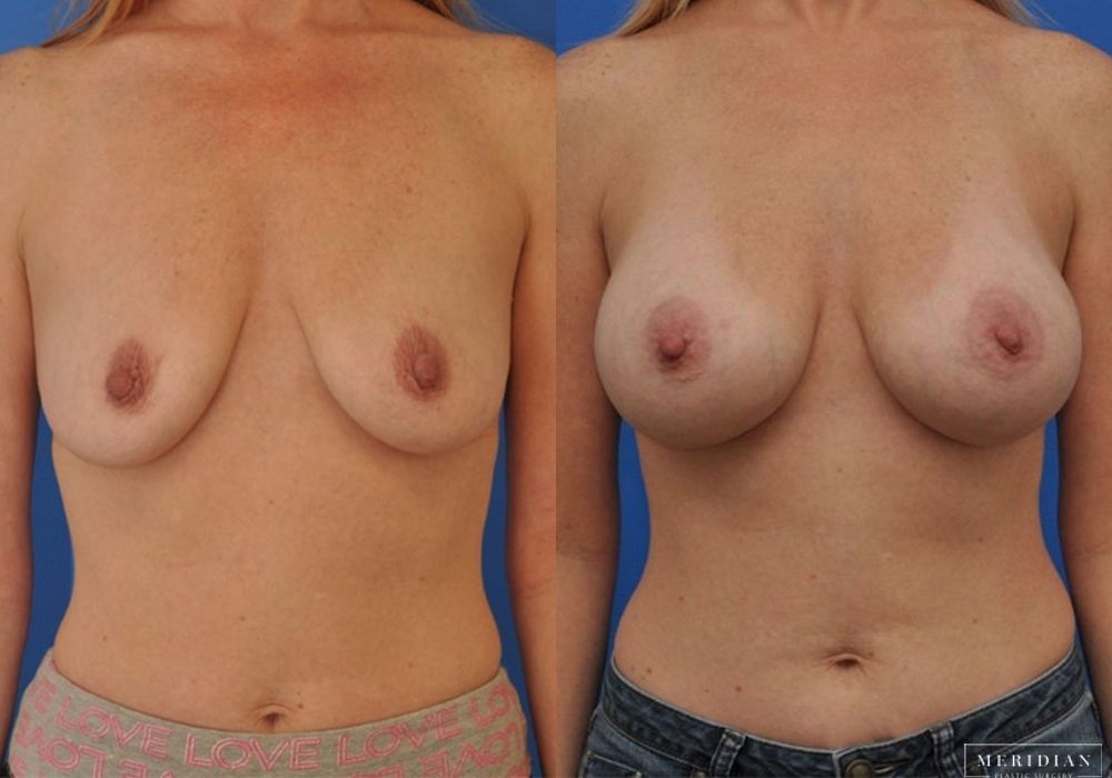 Breast Augmentation - Case 8042