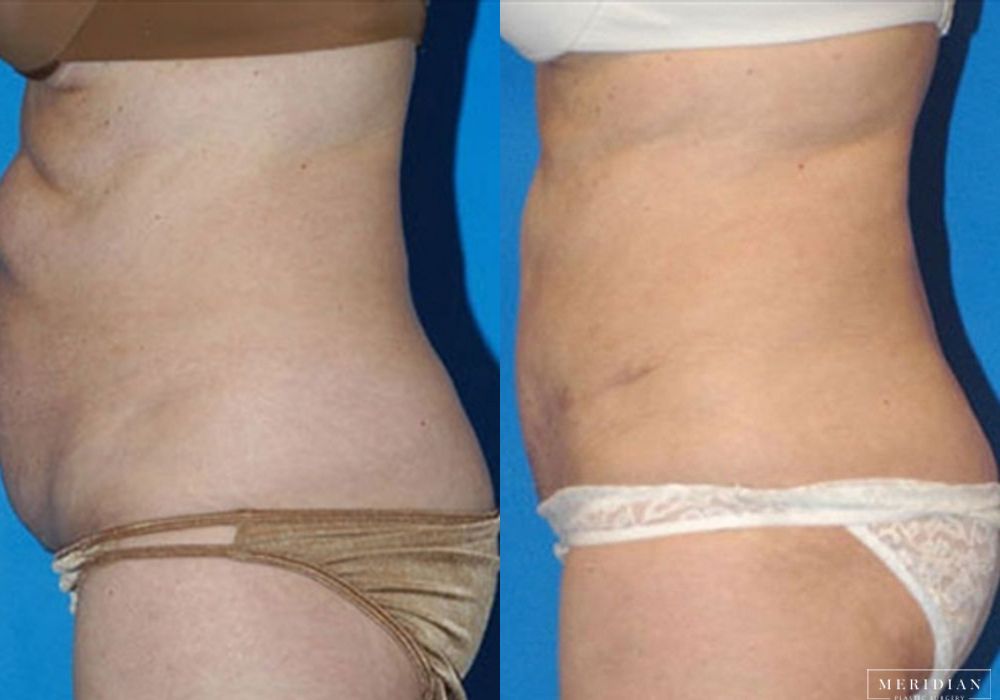 Body Contouring - Thumbnail 2