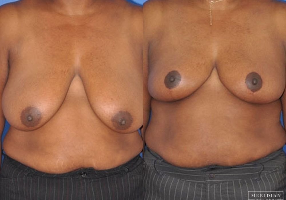 Breast Lift - Case 7865