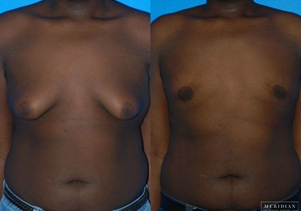 Gynecomastia - Case 7900