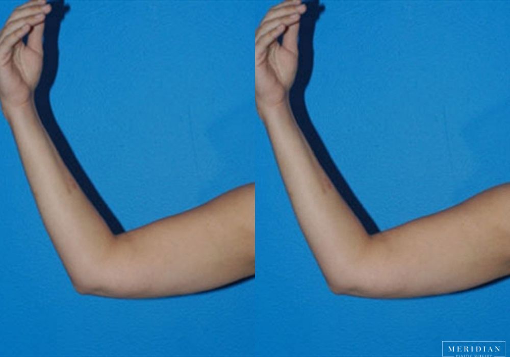 Body Contouring - Thumbnail 2