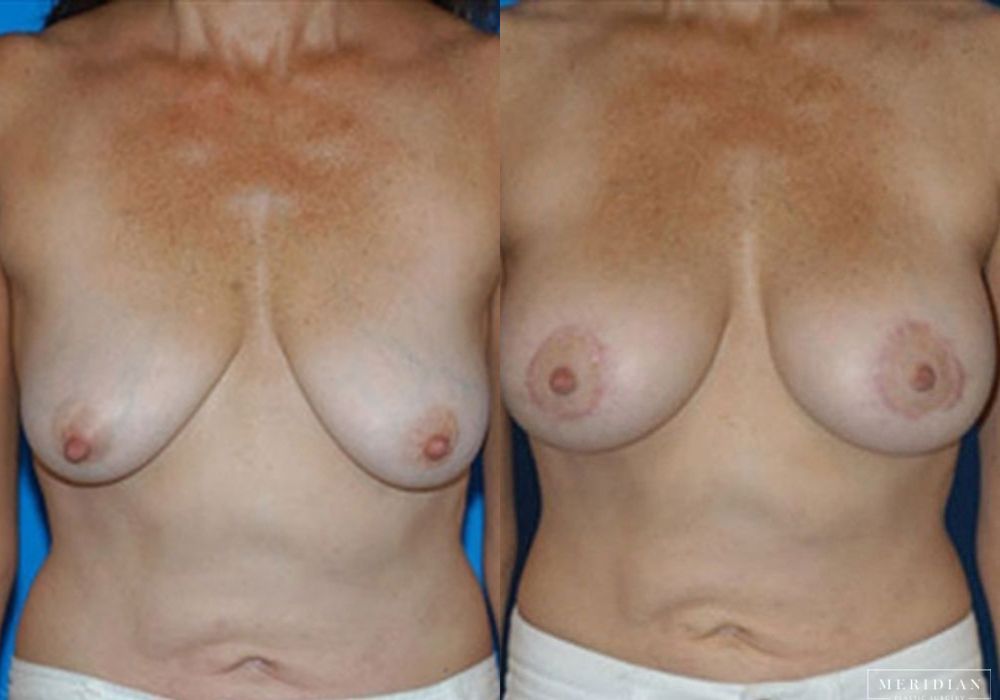 Body Contouring - Case 7985