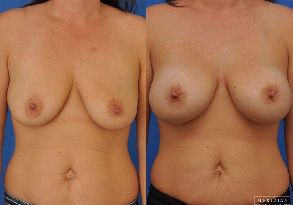 Breast Augmentation - Case 8044