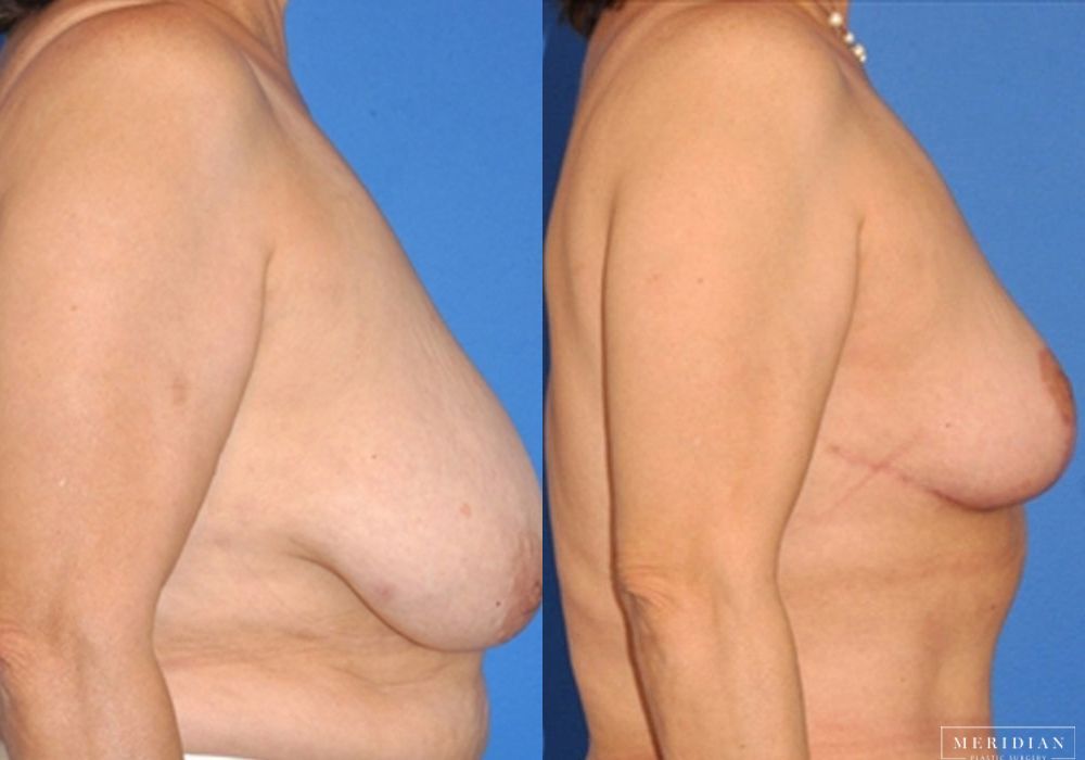 Breast Lift - Thumbnail 2