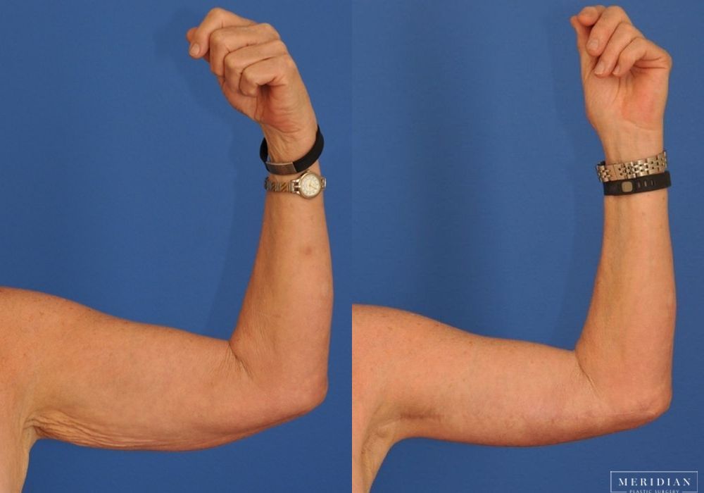 Body Contouring - Thumbnail 2