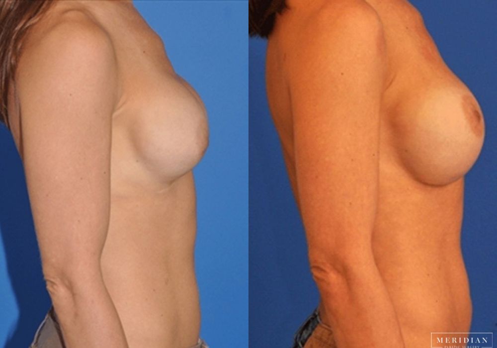 Breast Revision - Thumbnail 2