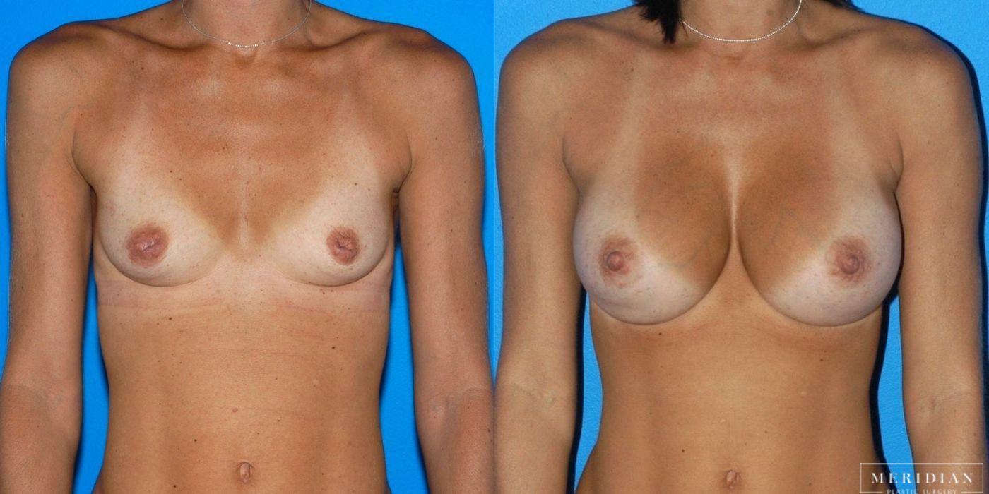 Breast Augmentation - Case 8025
