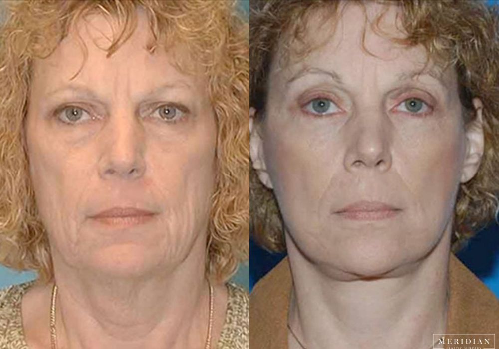 Brow Lift - Case 7911