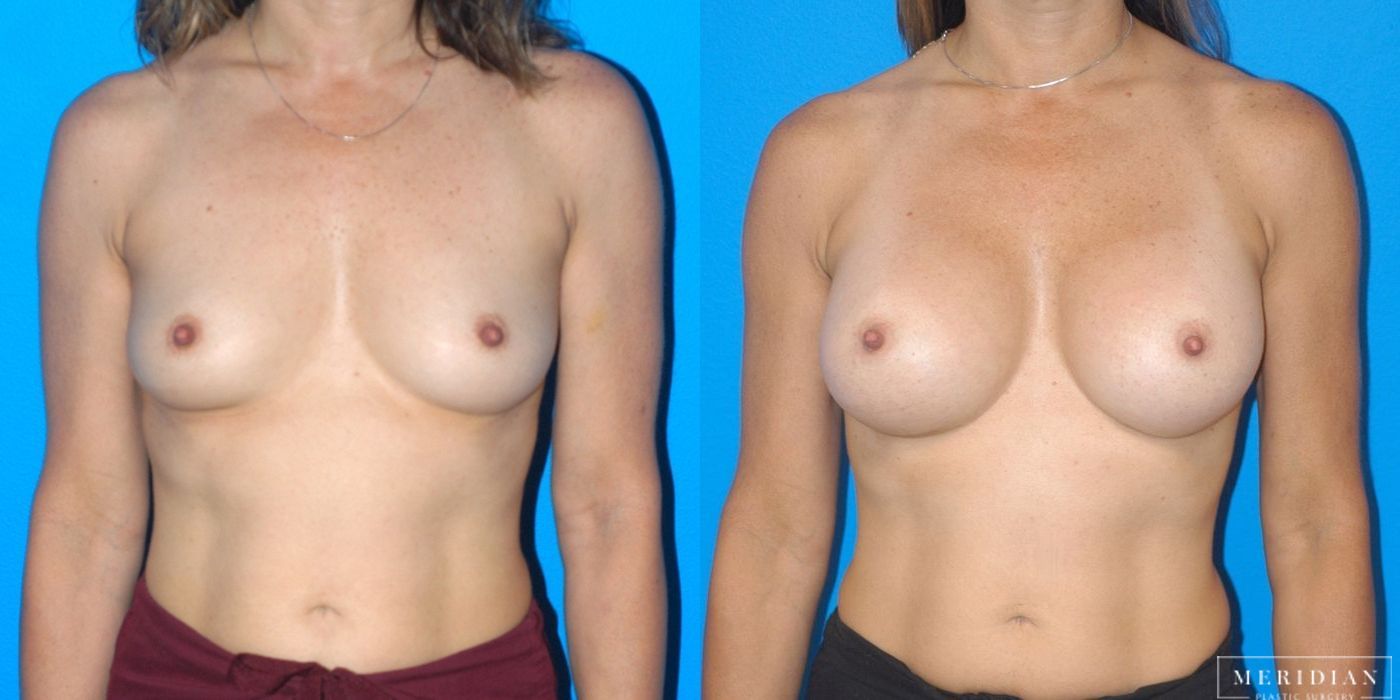 Breast Augmentation - Case 8055