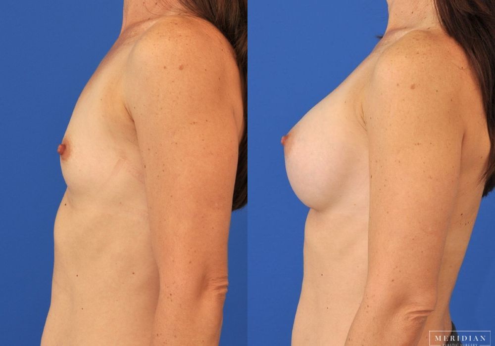 Breast Augmentation - Thumbnail 4