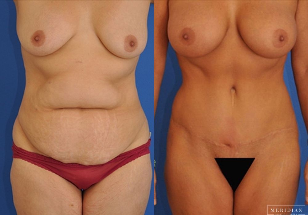 Before and after procedure result