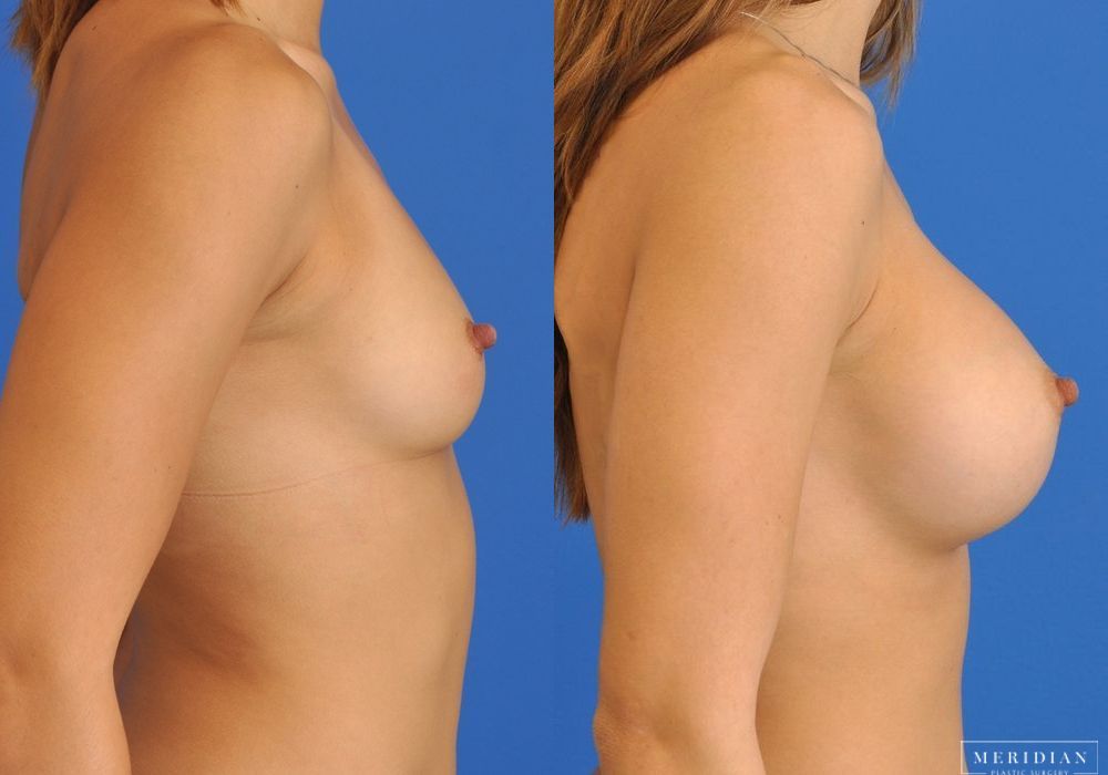 Breast Augmentation - Thumbnail 3