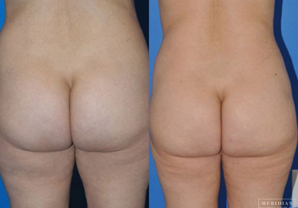 Body Contouring - Thumbnail 2