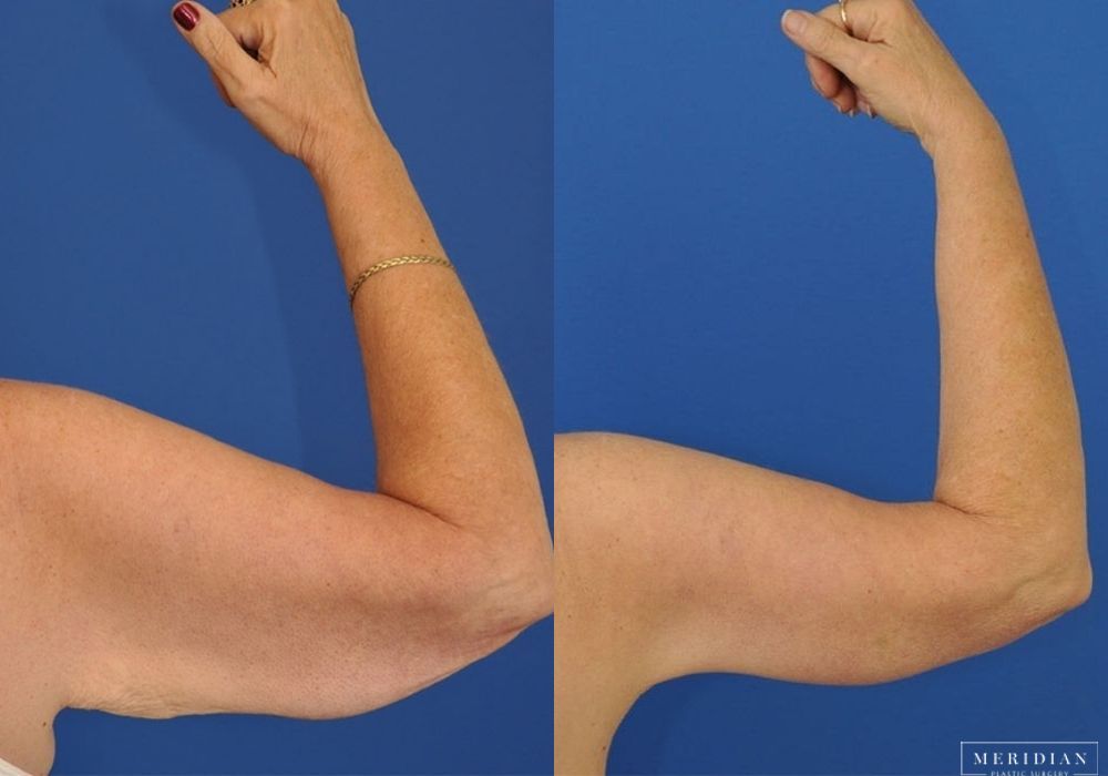 Arm Lift - Thumbnail 2