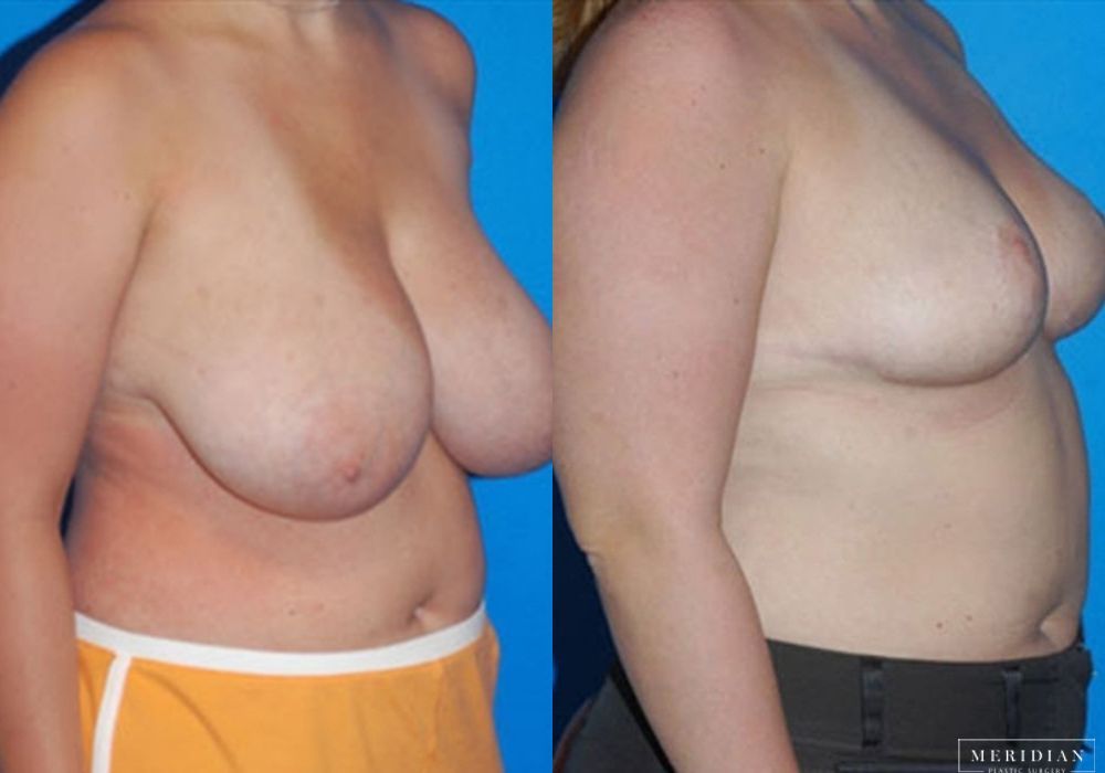 Breast Reduction - Thumbnail 2