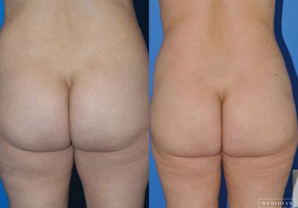 Tummy Tuck - Thumbnail 2