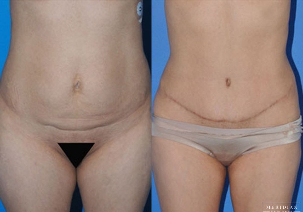 Tummy Tuck - Case 7997