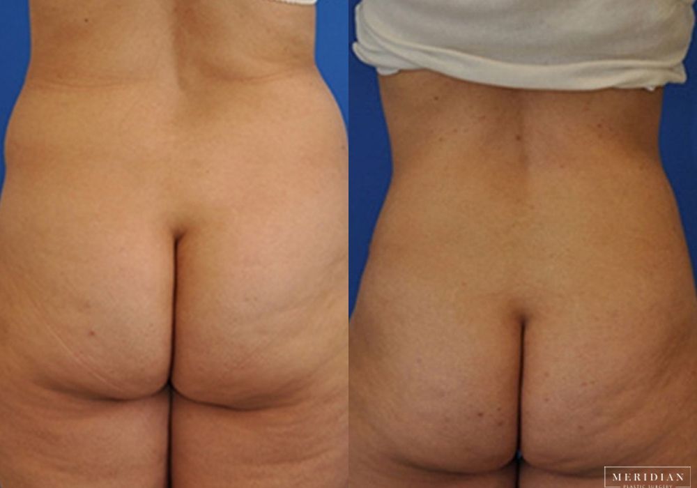 Body Contouring - Thumbnail 3