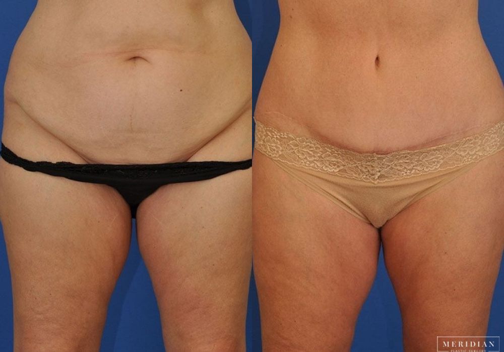 Tummy Tuck - Case 8006