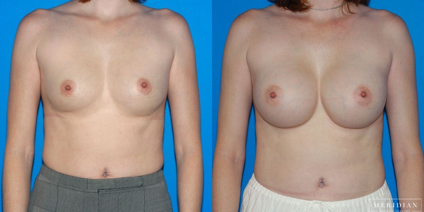 Breast Augmentation - Thumbnail 2