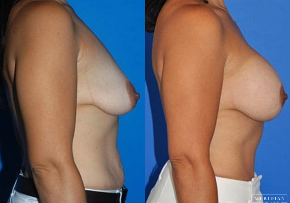 Breast Lift - Thumbnail 2
