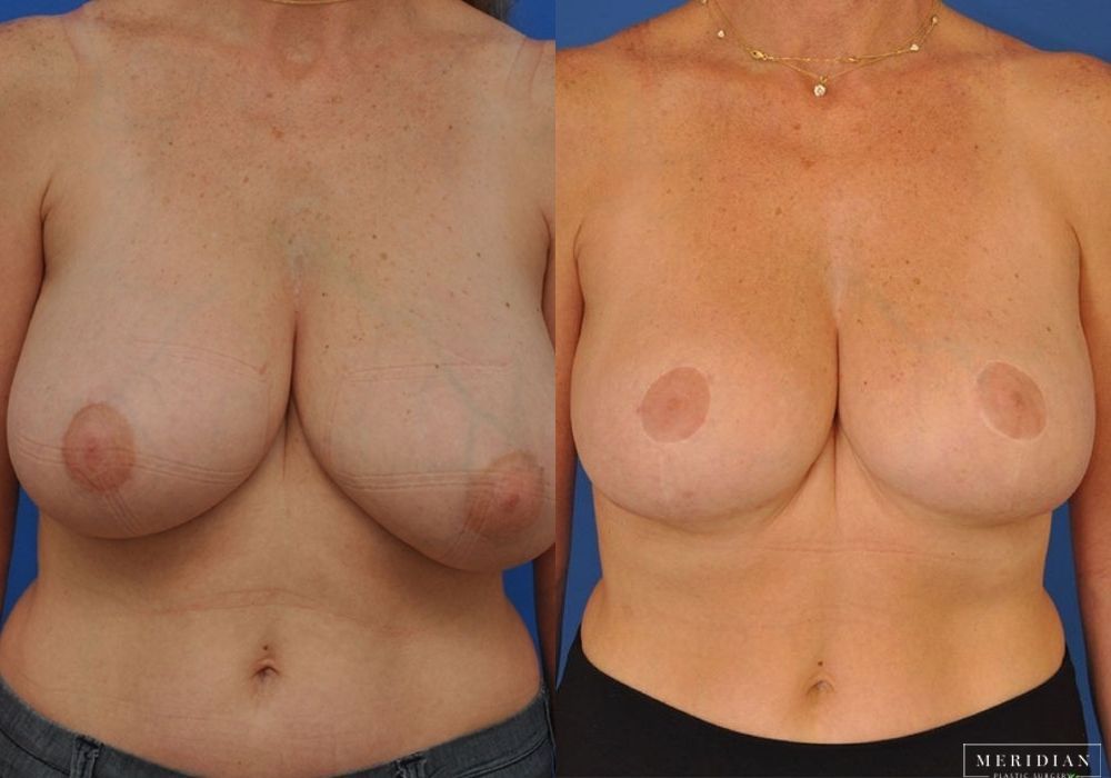 Breast Lift - Case 7876