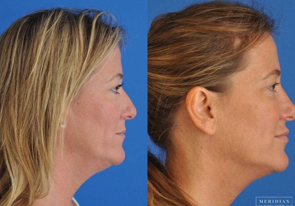 Injectables - Thumbnail 2