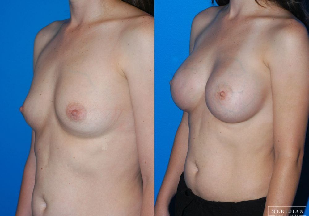 Breast Augmentation - Thumbnail 2