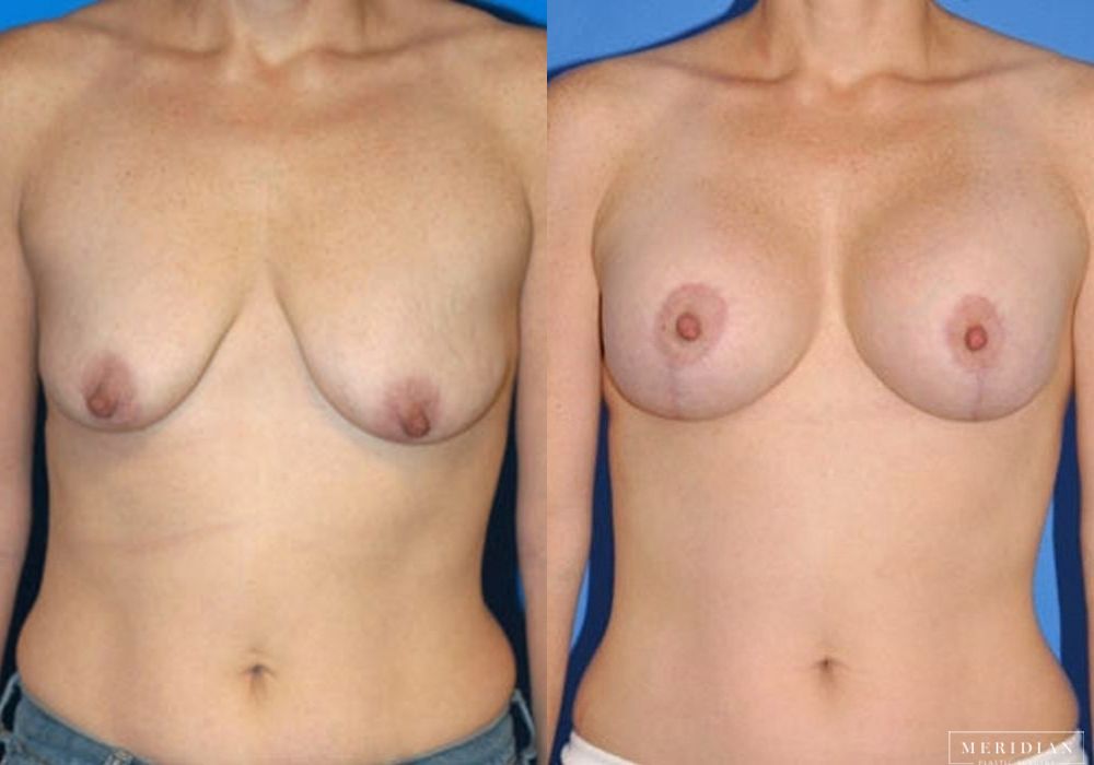 Breast Lift - Case 7873