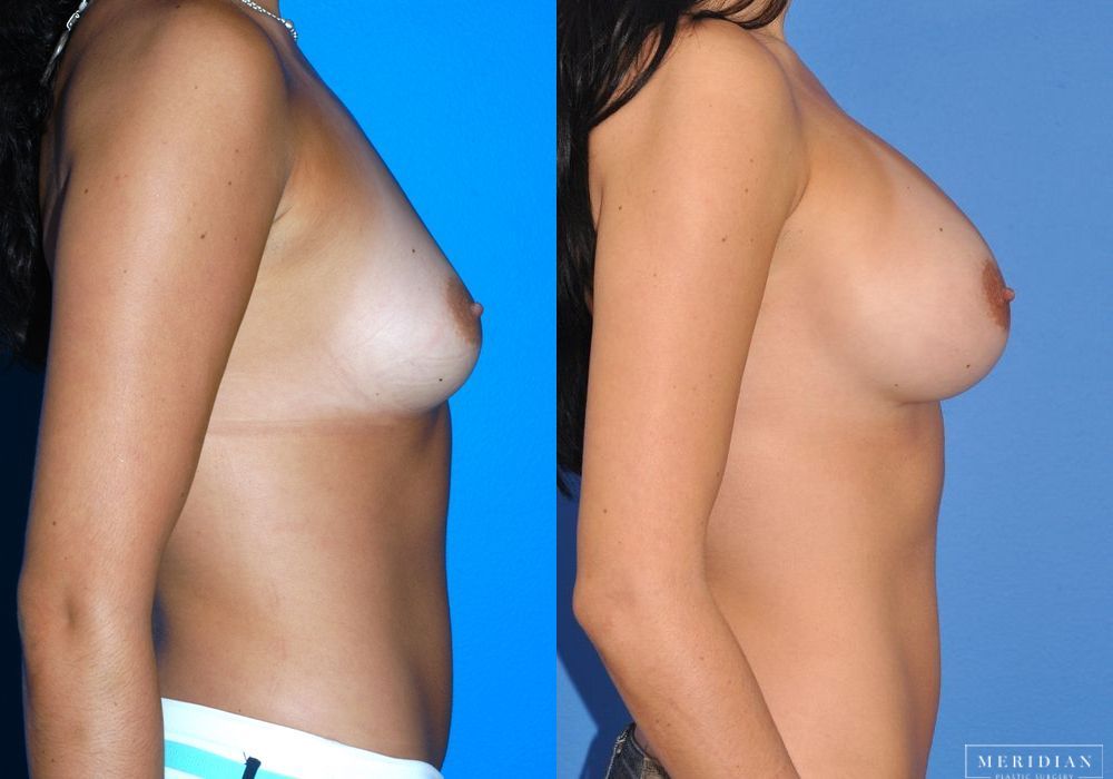 Breast Augmentation - Thumbnail 3