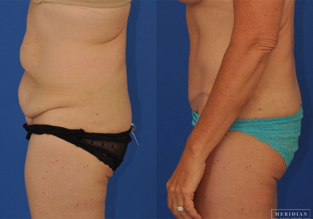 Tummy Tuck - Thumbnail 2