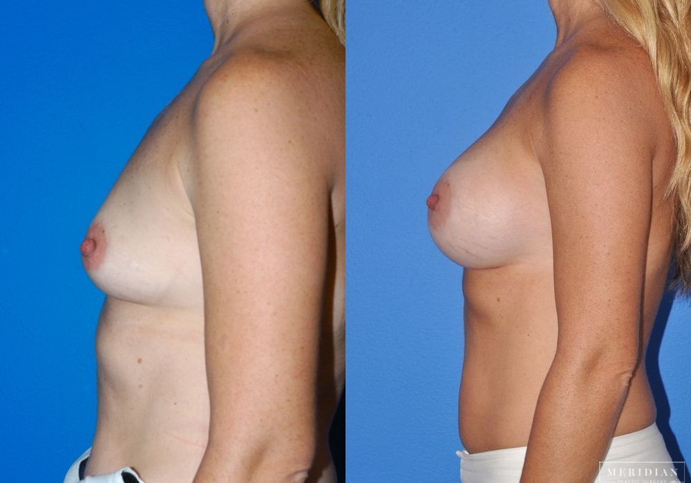 Breast Augmentation - Thumbnail 3