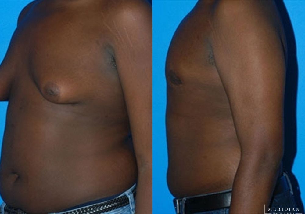 Gynecomastia - Thumbnail 2