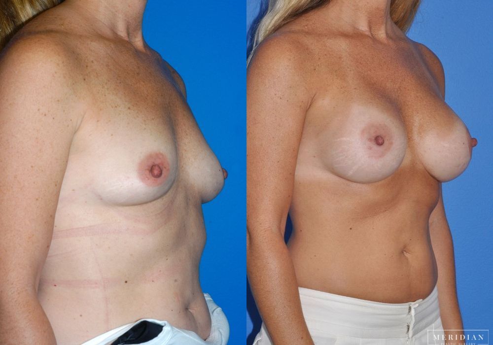 Breast Augmentation - Thumbnail 2