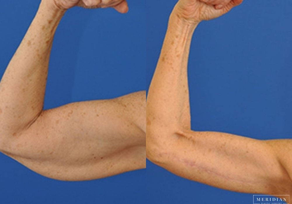 Body Contouring - Case 7973