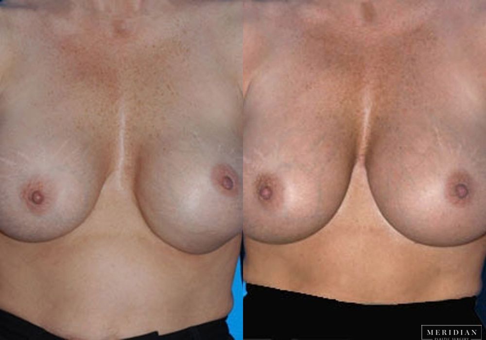 Before and after procedure result