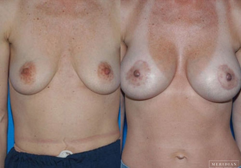 Body Contouring - Case 7981